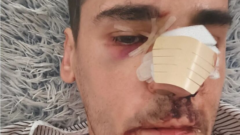 El periodista Fonsi Loaiza tras la agresión